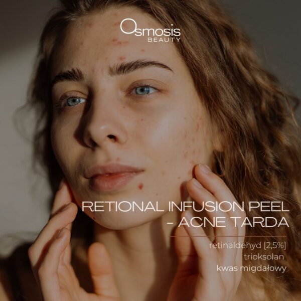 RETINAL INFUSION PEEL- ACNE TARDA